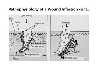Pathophysiology of a Wound Infection cont...
 