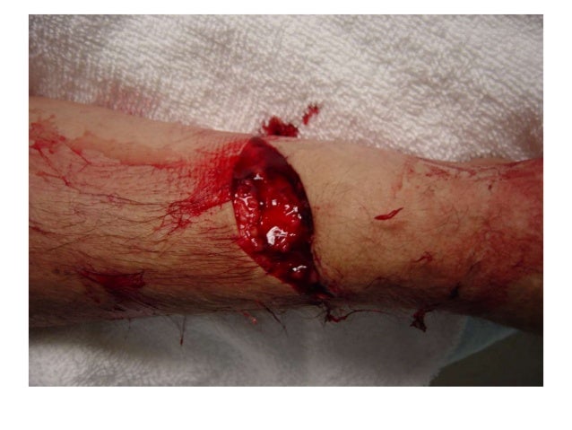 wound presentation