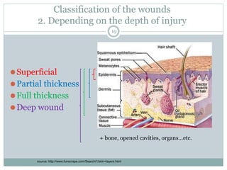 ⚫Superficial
⚫Partial thickness
⚫Full thickness
⚫Deep wound
Classification of the wounds
2. Depending on the depth of inju...
