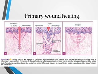 Primary wound healing
 