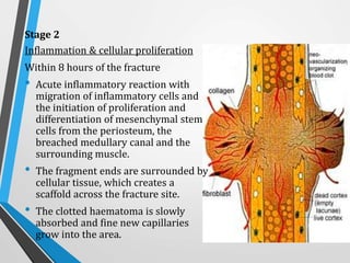 Stage 2
Inflammation & cellular proliferation
Within 8 hours of the fracture
• Acute inflammatory reaction with
migration of inflammatory cells and
the initiation of proliferation and
differentiation of mesenchymal stem
cells from the periosteum, the
breached medullary canal and the
surrounding muscle.
• The fragment ends are surrounded by
cellular tissue, which creates a
scaffold across the fracture site.
• The clotted haematoma is slowly
absorbed and fine new capillaries
grow into the area.
 