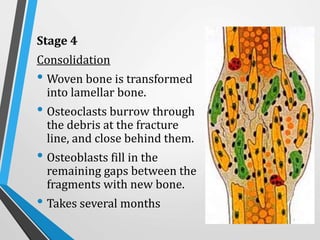 Stage 4
Consolidation
• Woven bone is transformed
into lamellar bone.
• Osteoclasts burrow through
the debris at the fracture
line, and close behind them.
• Osteoblasts fill in the
remaining gaps between the
fragments with new bone.
• Takes several months
 