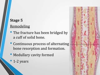 Stage 5
Remodeling
• The fracture has been bridged by
a cuff of solid bone.
• Continuous process of alternating
bone resorption and formation.
• Medullary cavity formed
• 1-2 years
 