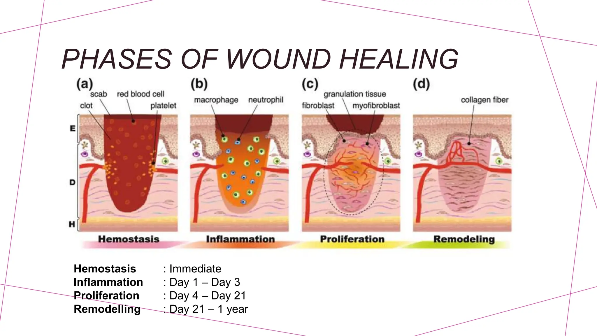 Stages of Wound and Bone Healing (Ortho) PPTX
