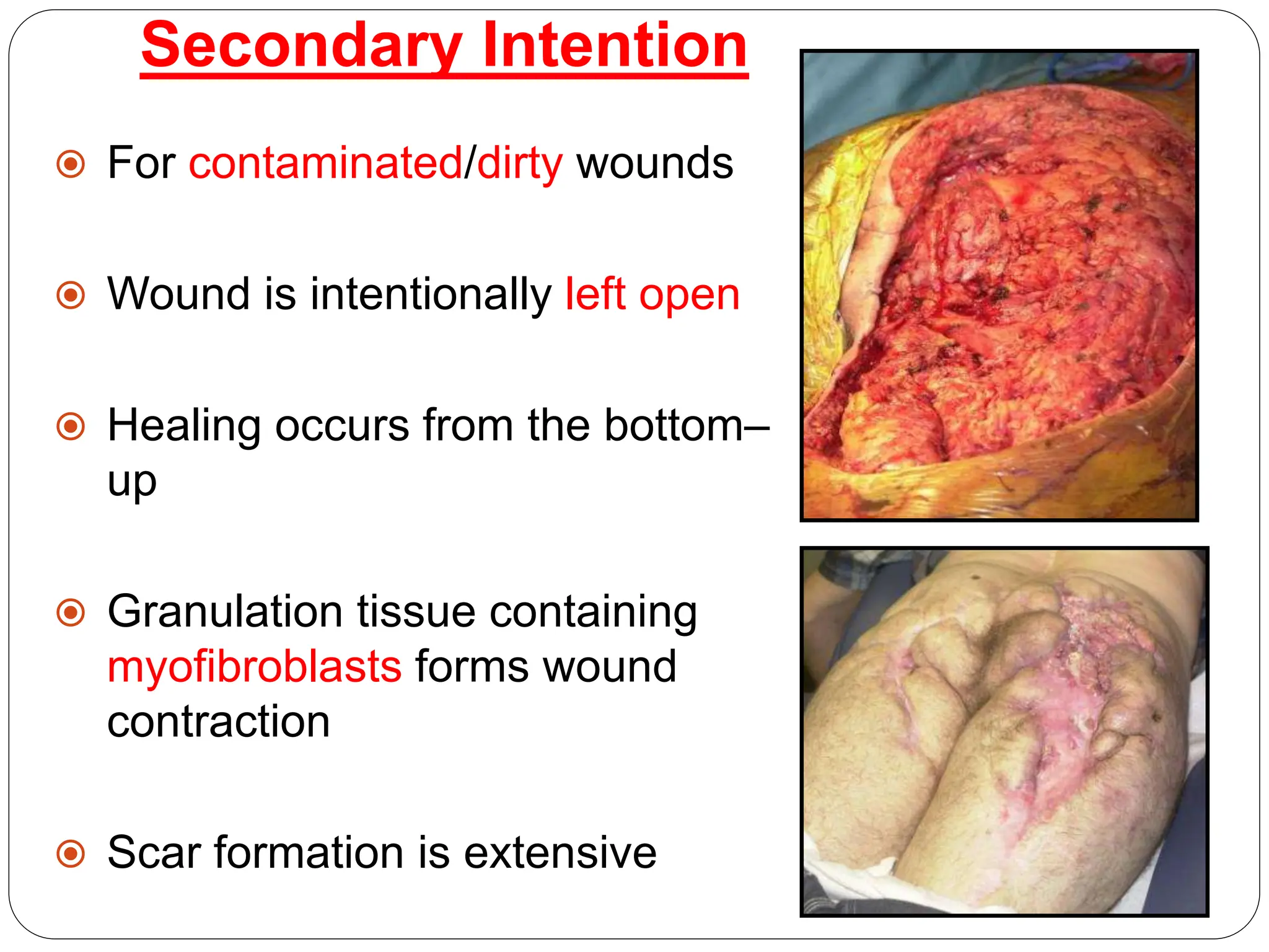 wound and types wound healing and dressing.pptx