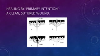 HEALING BY ‘PRIMARY INTENTION’:
A CLEAN, SUTURED WOUND.
 