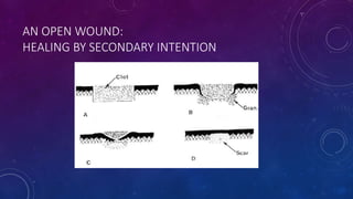 AN OPEN WOUND:
HEALING BY SECONDARY INTENTION
 