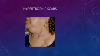 HYPERTROPHIC SCARS
 