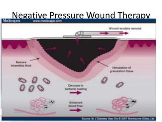Negative Pressure Wound Therapy
 