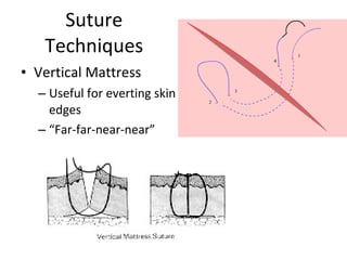 Suture Techniques <ul><li>Vertical Mattress </li></ul><ul><ul><li>Useful for everting skin edges </li></ul></ul><ul><ul><l...