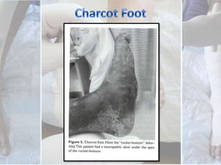 Ischemic Ulcer	Wound ischemia can be diagnosed by the presence of necrotic tissue or gangrene within a wound, non palpable pulses or confirmatory vascular testing. 