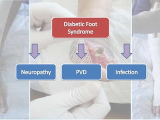 Diabetic Foot SyndromeNeuropathyPVDInfection