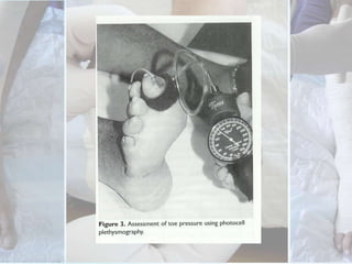 In diabetic patient, the ABI is falsely elevated. Can assess the peripheral circulation by measuring the toe systolic pressure (normal > 40 mmHg) using either a strain gauge sensor or photoplethysmography.