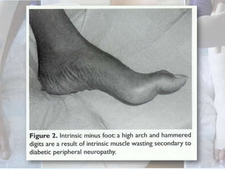 Foot Inspection For :Deformityulcershammer toes loss of archersCharcot foot Texture of skinIntegrity of skinTexture of nailsQuality of subcutaneous tissuePresence of hair