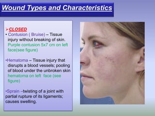 Wound Types and Characteristics
CLOSED
• Contusion ( Bruise) – Tissue
injury without breaking of skin.
Purple contusion 5x7 cm on left
face(see figure)
•Hematoma – Tissue injury that
disrupts a blood vessels; pooling
of blood under the unbroken skin
hematoma on left face (see
figure)
•Sprain –twisting of a joint with
partial rupture of its ligaments;
causes swelling.
 