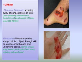 .
OPEND
•Abrasion- Traumatic scraping
away of surface layers of skin.
(raw appearing abraded area
diameter on lateral aspect of lower
leg).(see figure)
•Puncture – Wound made by
sharp, pointed object through skin
or mucous membranes and
underlying tissue, (Small circular
entry wound on Rt palm from sharp
pointing nail see figure)
 
