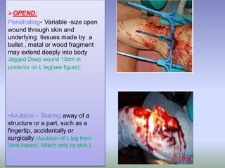 OPEND:
Penetrating- Variable -size open
wound through skin and
underlying tissues made by a
bullet , metal or wood fragment
may extend deeply into body
Jagged Deep wound 10cm in
posterior on L leg(see figure).
•Avulsion – Tearing away of a
structure or a part, such as a
fingertip, accidentally or
surgically.(Avulsion of L leg from
Vent Aspect. Attach only by skin.)
 
