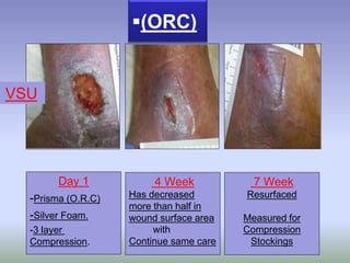 Day 1
-Prisma (O.R.C)
-Silver Foam.
-3 layer
Compression.
4 Week
Has decreased
more than half in
wound surface area
with
Continue same care
7 Week
Resurfaced
Measured for
Compression
Stockings
(ORC)
VSU
 