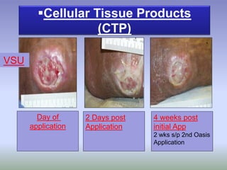 Day of
application
2 Days post
Application
4 weeks post
initial App
2 wks s/p 2nd Oasis
Application
Cellular Tissue Products
(CTP)
VSU
 