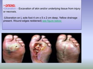 OPEND:
•Ulceration – Excavation of skin and/or underlying tissue from injury
or necrosis.
(Ulceration on L sole foot 4 cm x 5 x 2 cm deep. Yellow drainage
present. Wound edges reddened) see figure below:
 