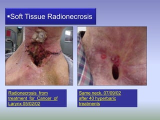Soft Tissue Radionecrosis
Radionecrosis from
treatment for Cancer of
Larynx 05/02/02
Same neck, 07/09/02
after 40 hyperbaric
treatments
 