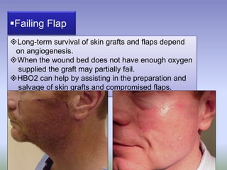Failing Flap
Long-term survival of skin grafts and flaps depend
on angiogenesis.
When the wound bed does not have enough oxygen
supplied the graft may partially fail.
HBO2 can help by assisting in the preparation and
salvage of skin grafts and compromised flaps.
 