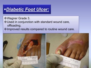 Diabetic Foot Ulcer:
Wagner Grade 3.
Used in conjunction with standard wound care,
offloading.
Improved results compared to routine wound care.
 