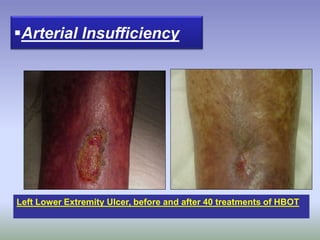 Arterial Insufficiency
Left Lower Extremity Ulcer, before and after 40 treatments of HBOT
 