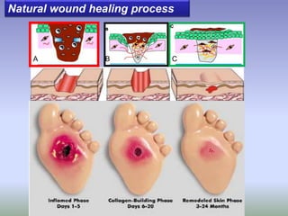 Natural wound healing process
A B C
 