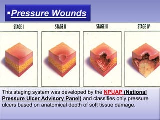 Pressure Wounds
This staging system was developed by the NPUAP (National
Pressure Ulcer Advisory Panel) and classifies only pressure
ulcers based on anatomical depth of soft tissue damage.
 