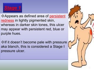 Stage 1
Appears as defined area of persistent
redness in lightly pigmented skin,
whereas in darker skin tones, this ulcer
may appear with persistent red, blue or
purple hues.
If it doesn’t become pale with pressure
aka blanch, this is considered a Stage I
pressure ulcer.
 