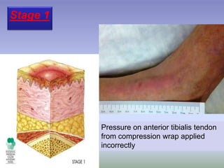 Pressure on anterior tibialis tendon
from compression wrap applied
incorrectly
Stage 1
 