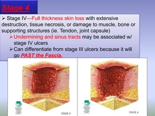 Stage 4
 Stage IV—Full thickness skin loss with extensive
destruction, tissue necrosis, or damage to muscle, bone or
supporting structures (ie. Tendon, joint capsule)
Undermining and sinus tracts may be associated w/
stage IV ulcers
Can differentiate from stage III ulcers because it will
go PAST the Fascia.
 