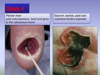 Stage 4
Plantar heel:
past subcutaneous level and goes
to the calcaneous bone
Sacrum, eschar, past sub-
cutaneos tendon exposed
 