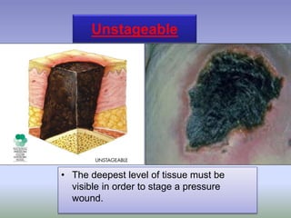 Unstageable
• The deepest level of tissue must be
visible in order to stage a pressure
wound.
 
