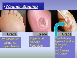 Wagner Staging
Grade
0
Grade
1
Grade
2Pre-ulcerative
callus, no
open lesion
Superficial
diabetic
Foot ulcer
Penetrates to
ligament tendon,
bone, joint,
fascia
NO Abscess,
NO Osteo
 