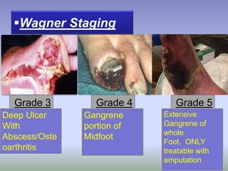 Wagner Staging
Grade 3 Grade 4 Grade 5
Deep Ulcer
With
Abscess/Oste
oarthritis
Gangrene
portion of
Midfoot
Extensive
Gangrene of
whole
Foot. ONLY
treatable with
amputation
 