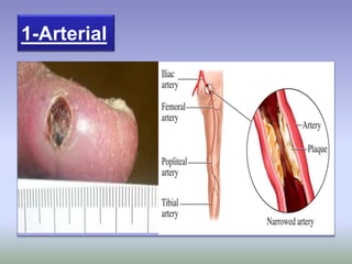 1-Arterial
 