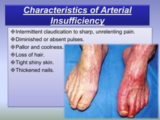 Etiology:
Intermittent claudication to sharp, unrelenting pain.
Diminished or absent pulses.
Pallor and coolness.
Loss of hair.
Tight shiny skin.
Thickened nails.
Characteristics of Arterial
Insufficiency
 