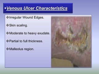 Irregular Wound Edges.
Skin scaling.
Moderate to heavy exudate.
Partial to full thickness.
Malleolus region.
Venous Ulcer Characteristics
 
