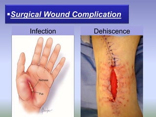 Surgical Wound Complication
Infection Dehiscence
 