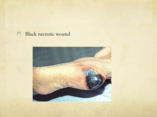 Black necrotic wound
 