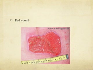 Red wound
 