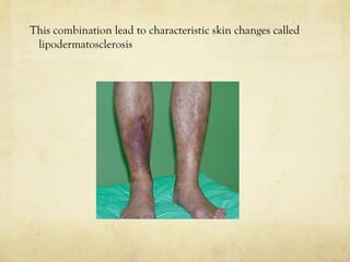 This combination lead to characteristic skin changes called
lipodermatosclerosis
 