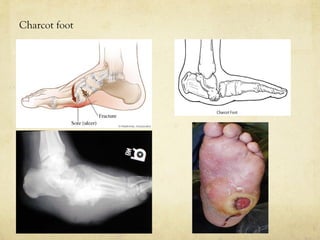 Charcot foot
 