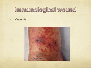• Vasculitis
 