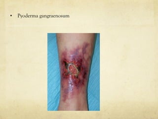 • Pyoderma gangraenosum
 