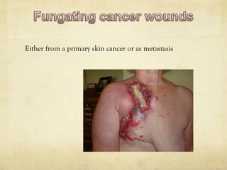 Either from a primary skin cancer or as metastasis
 