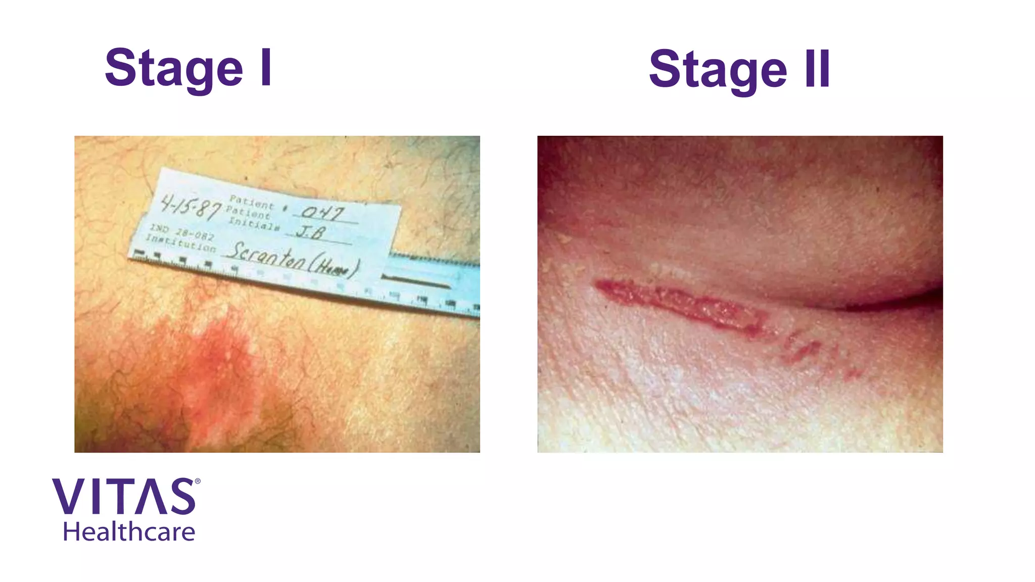 Wound Care 101 | PPTX