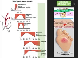 REMODELING
(MATURATION) PHASE 13
 